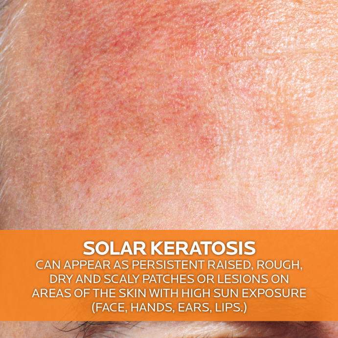 La Roche-Posay Anthelios KA+ Sunscreen SPF50+ 50mL