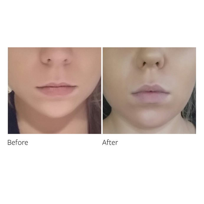 Freezeframe Lip Injection 10mL